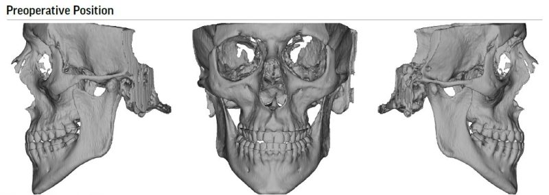 Preoperative position