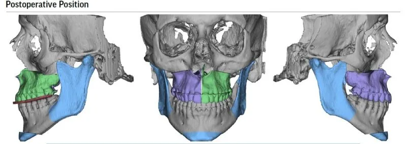Postoperative position