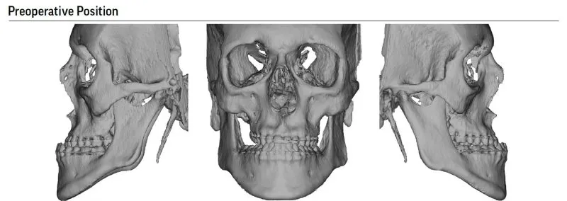 Preoperative position