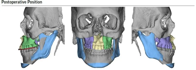 Postoperative position