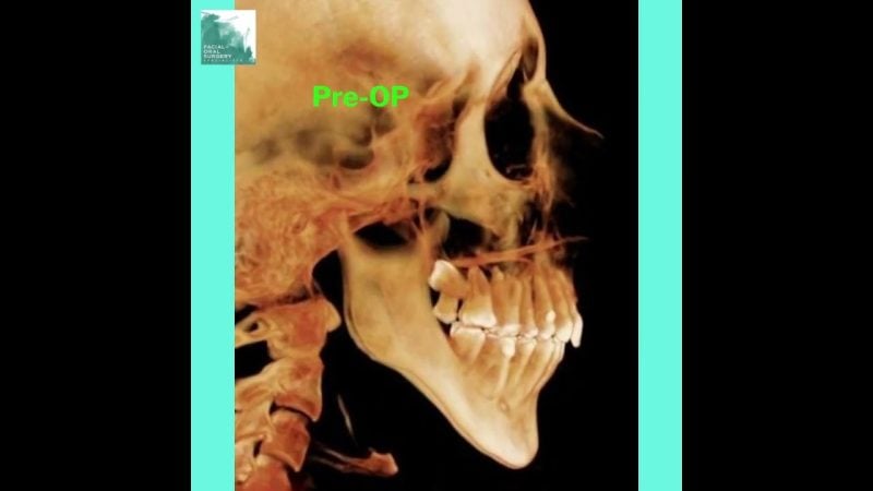 Airway and obstructive sleep apnea improvement after corrective jaw surgery video thumbnail