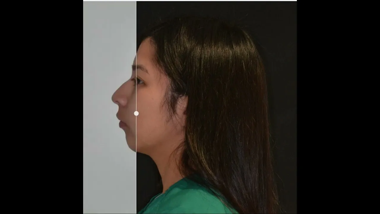Chin augmentation and enhancement video thumbnail